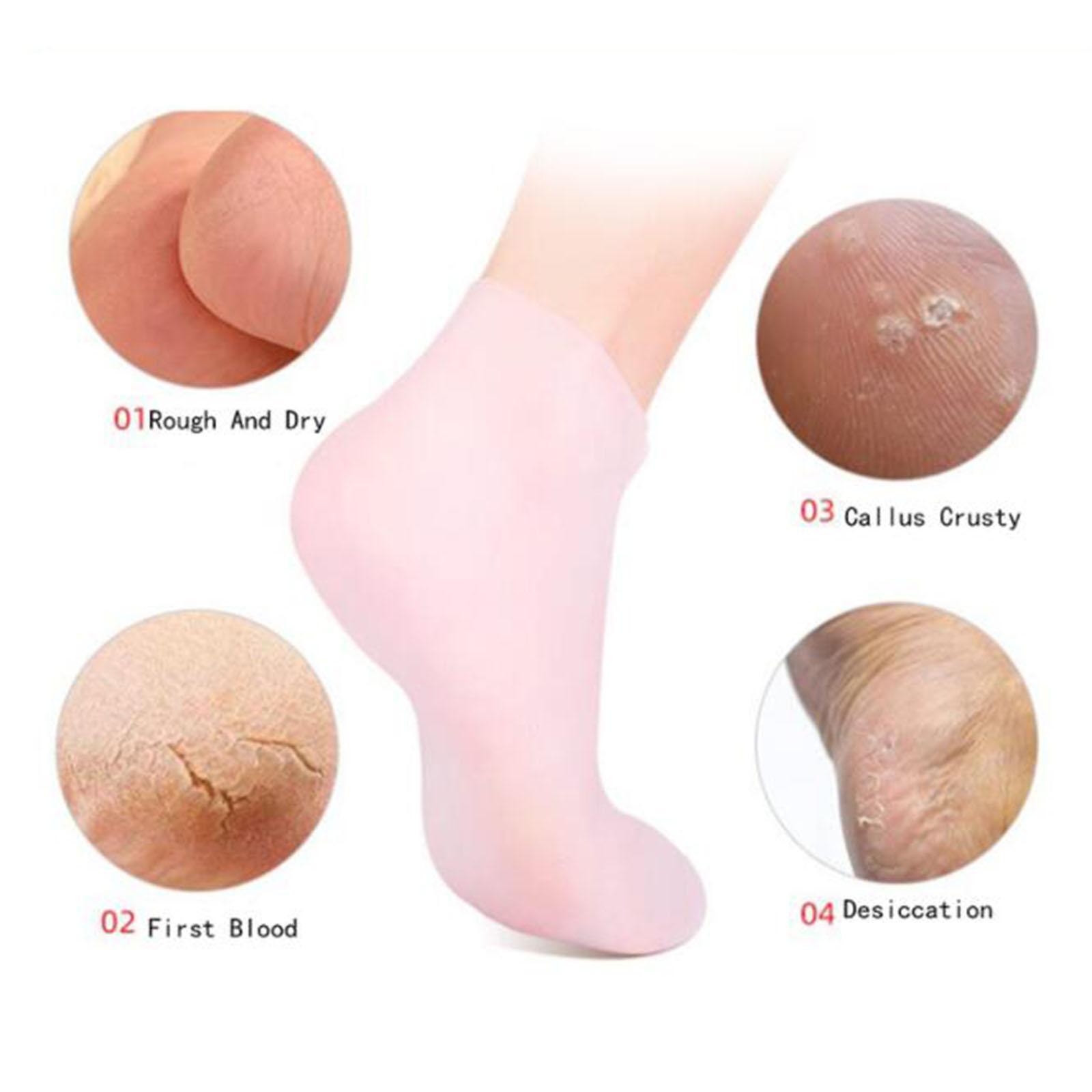 ถุงเท้าซิลิโคนเจลนุ่ม ถุงเท้าป - Xl Skincare บทวิจารณ์และราคา